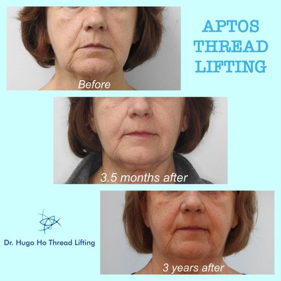Anti-Aging with a Facial Thread Lift